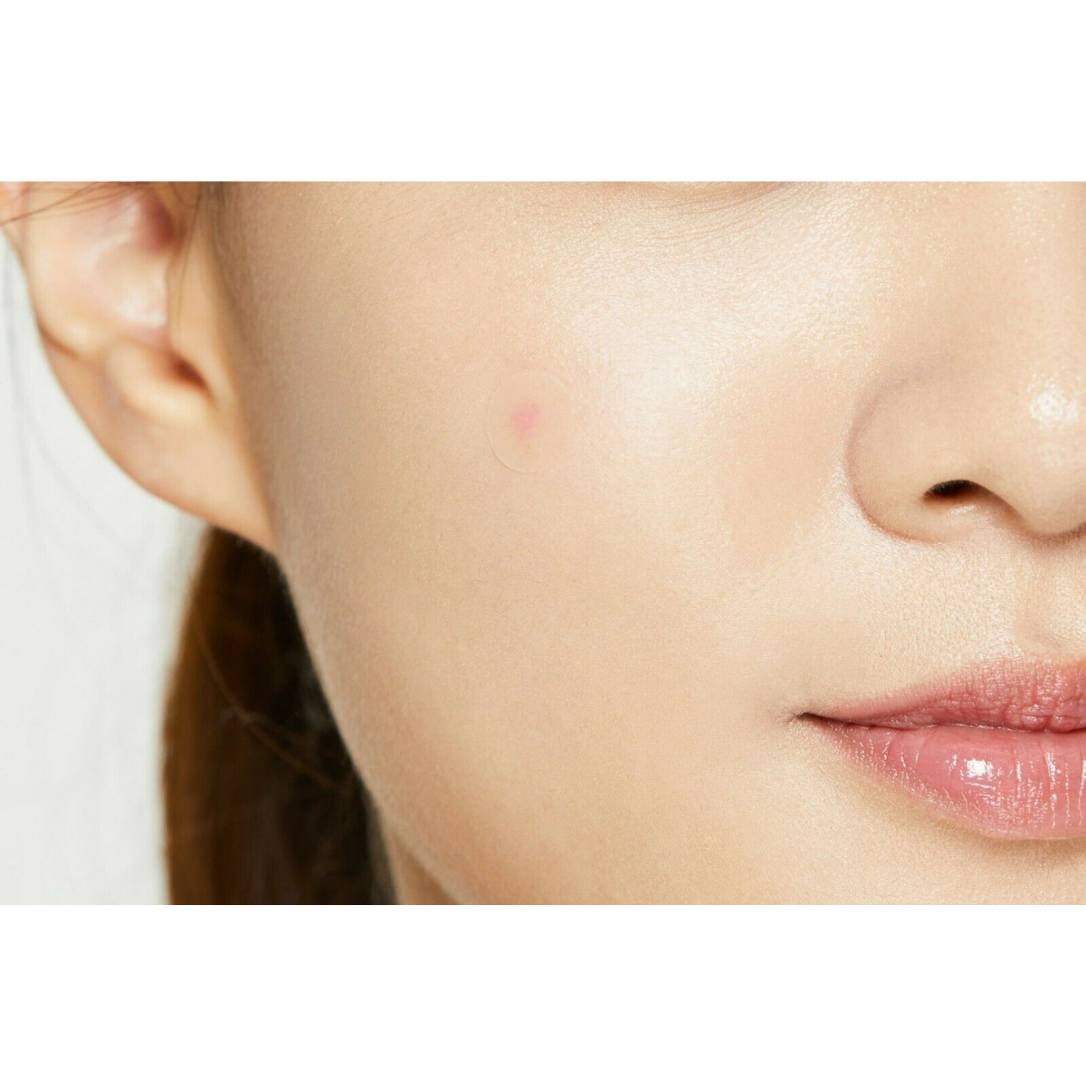 Acne | Spot | Pimple Patch