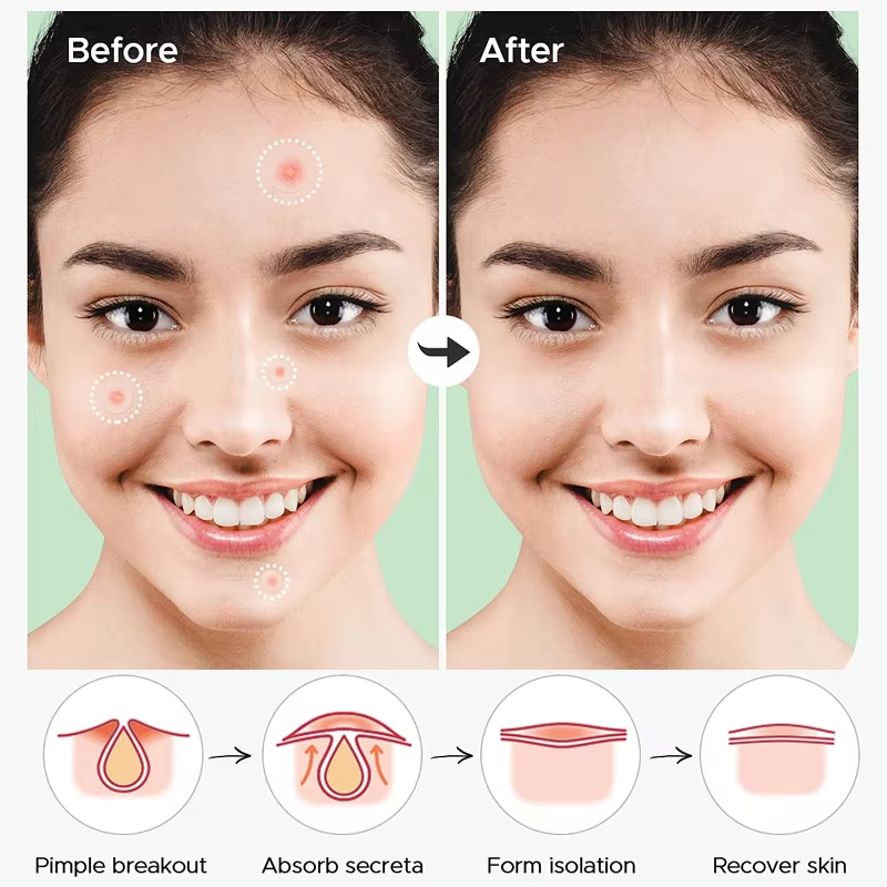 Acne | Spot | Pimple Patch
